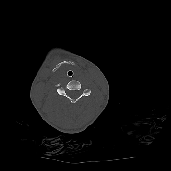 Atlanto-occipital dissociation (Traynelis type 1), C2 teardrop fracture, C6-7 facet joint dislocation (Radiopaedia 87655-104061 Axial bone window 52).jpg