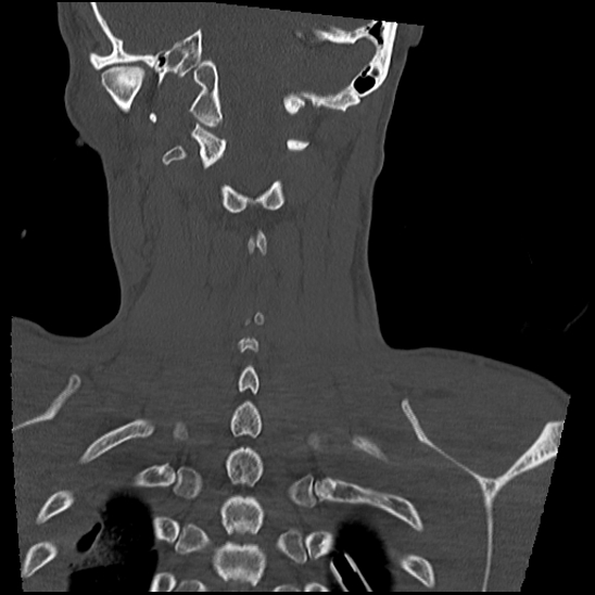 Atlanto-occipital dissociation (Traynelis type 1), C2 teardrop fracture, C6-7 facet joint dislocation (Radiopaedia 87655-104061 Coronal bone window 51).jpg