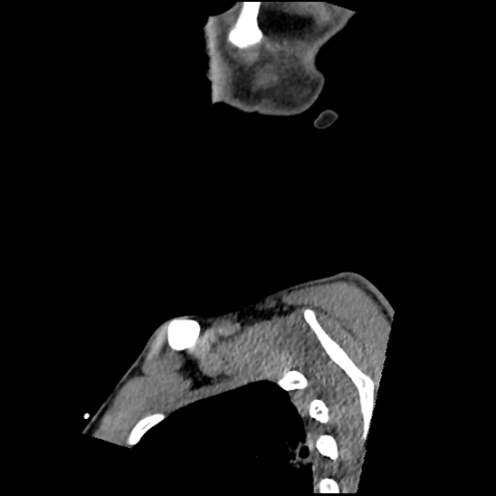 Atlanto-occipital dissociation (Traynelis type 1), C2 teardrop fracture, C6-7 facet joint dislocation (Radiopaedia 87655-104061 D 5).jpg