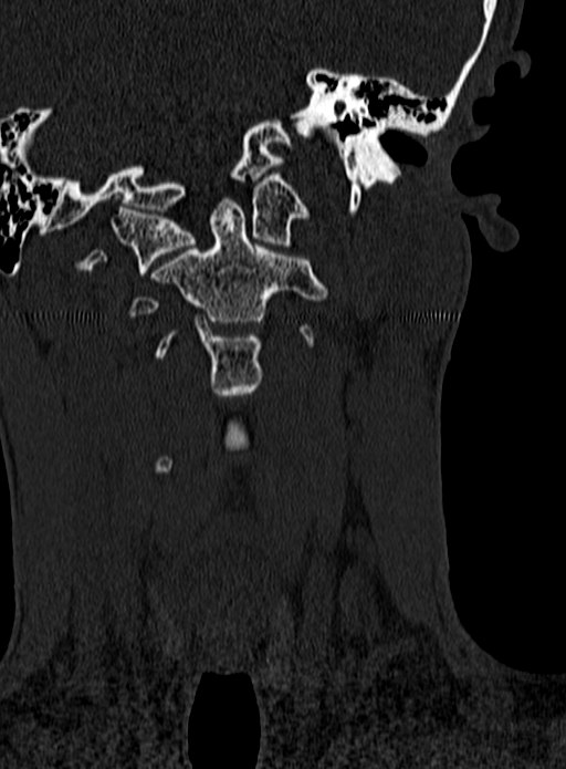 Atlantoaxial subluxation (Radiopaedia 44681-48450 Coronal bone window 24).jpg