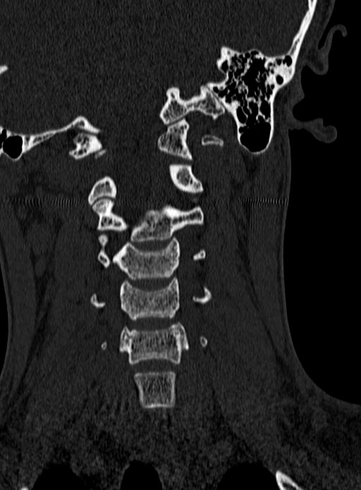 Atlantoaxial subluxation (Radiopaedia 44681-48450 Coronal bone window 56).jpg