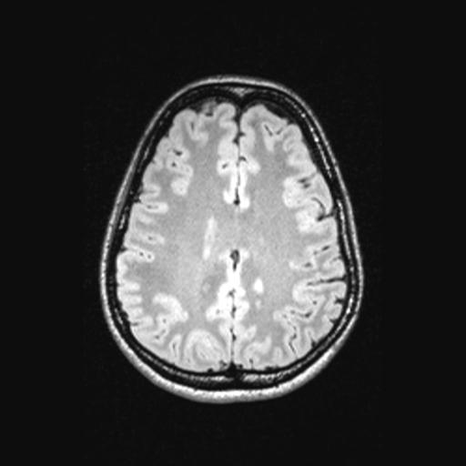 Atretic encephalocoele with inferior vermis hypoplasia (Radiopaedia 30443-31108 Axial 109).jpg