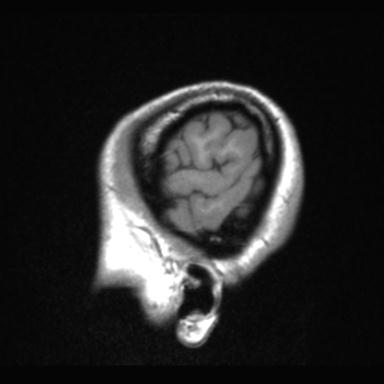 Atretic encephalocoele with inferior vermis hypoplasia (Radiopaedia 30443-31108 Sagittal T1 5).jpg