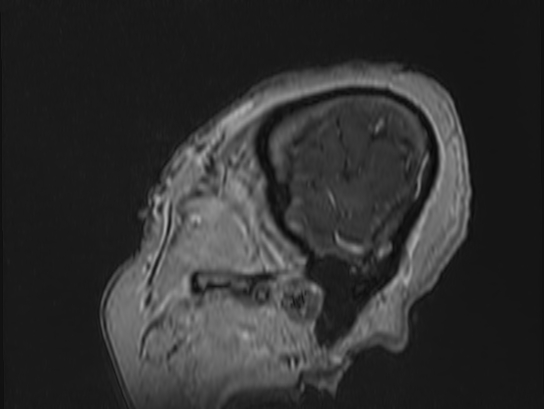Atypical meningioma (Radiopaedia 62985-71406 Sagittal T1 C+ 1).jpg