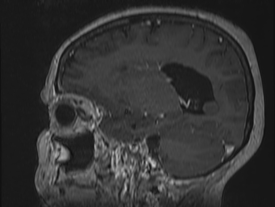 Atypical meningioma (Radiopaedia 62985-71406 Sagittal T1 C+ 28).jpg