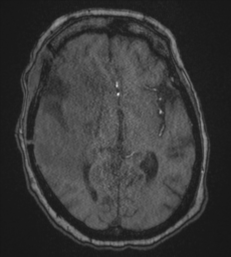 Atypical meningioma (WHO Grade II) (Radiopaedia 54742-60981 Axial MRA 48).png