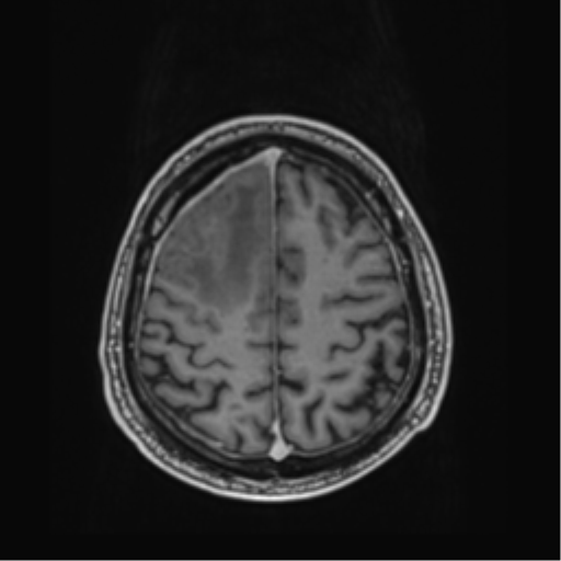 File:Atypical meningioma (WHO grade II) with brain invasion (Radiopaedia 57767-64729 Axial T1 C+ 39).png