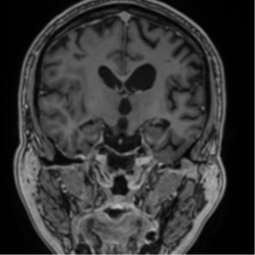 Atypical meningioma (WHO grade II) with brain invasion (Radiopaedia 57767-64729 Coronal T1 C+ 43).png