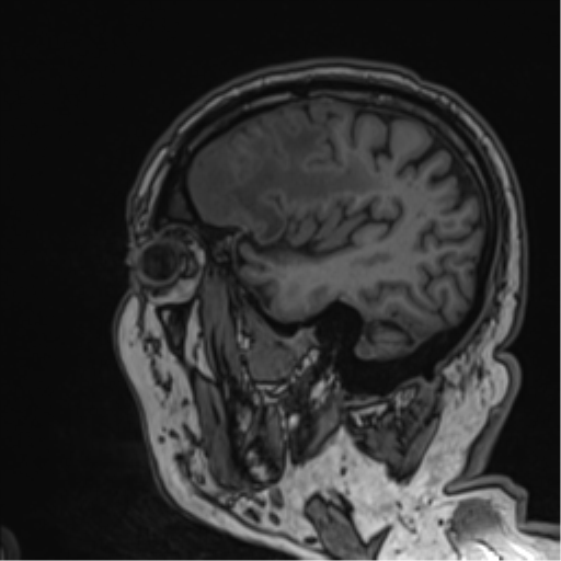 Atypical meningioma (WHO grade II) with brain invasion (Radiopaedia 57767-64729 Sagittal T1 51).png