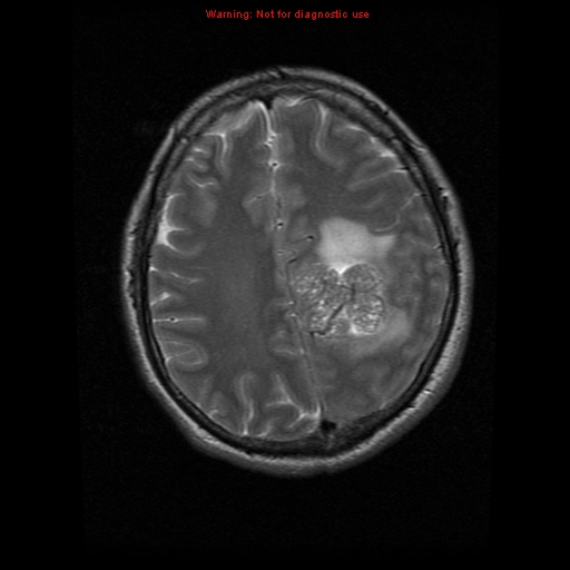 File:Atypical meningioma - grade II (Radiopaedia 13303-13305 Axial T2 16).jpg