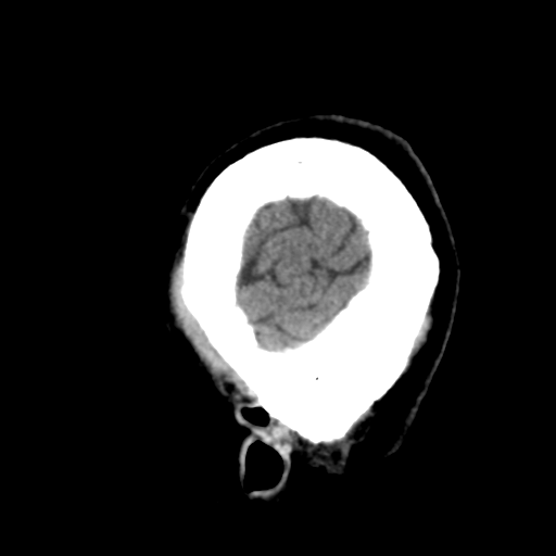 Atypical meningioma with skull invasion (Radiopaedia 34357-35649 E 50).png