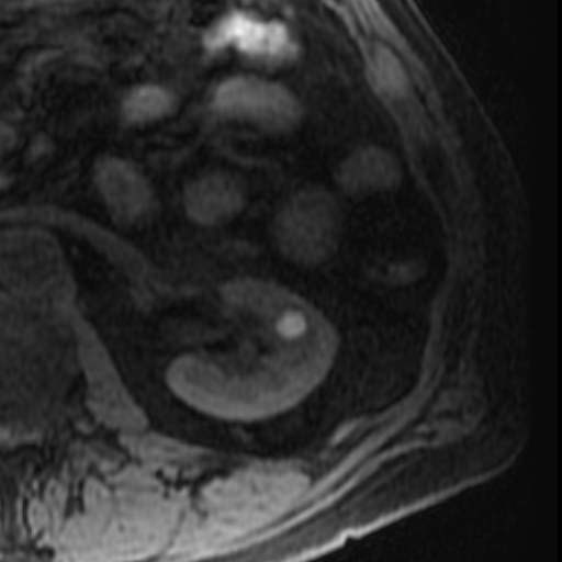 File:Atypical renal cyst on MRI (Radiopaedia 17349-17046 Axial T1 fat sat 18).jpg