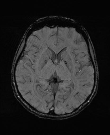 Autoimmune limbic encephalitis (Radiopaedia 30363-31005 SWI 40).jpg