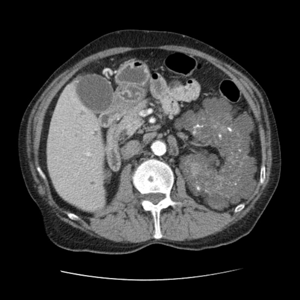 Autosomal dominant polycystic kidney disease (Radiopaedia 27851-28094 B 70).jpg