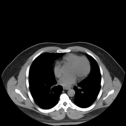 Autosomal dominant polycystic kidney disease (Radiopaedia 50259-55612 Axial non-contrast 5).jpg