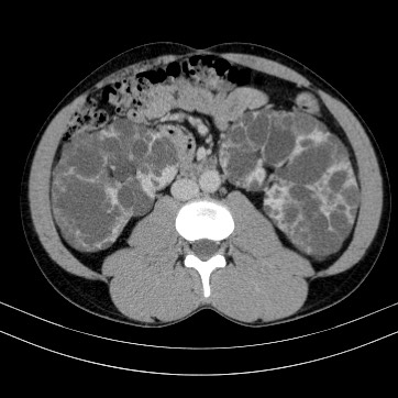 Autosomal dominant polycystic kidney disease (Radiopaedia 66349-75582 B 51).jpg