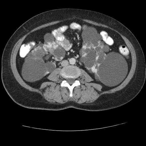 Autosomal dominant polycystic kidney disease with hepatic involvement (Radiopaedia 32693-33662 B 45).jpg
