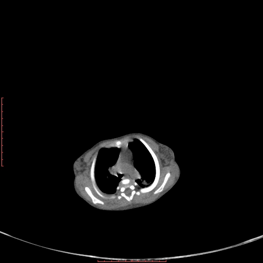 File:Autosomal recessive polycystic kidney disease associated with Caroli disease (Radiopaedia 61932-69984 Axial non-contrast 30).jpg