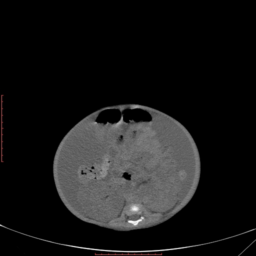 File:Autosomal recessive polycystic kidney disease associated with Caroli disease (Radiopaedia 61932-69984 B 228).jpg