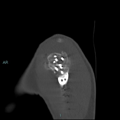 Avascular necrosis after fracture dislocations of the proximal humerus (Radiopaedia 88078-104653 Sagittal bone window 16).jpg