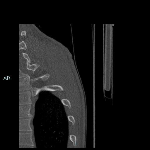 Avascular necrosis after fracture dislocations of the proximal humerus (Radiopaedia 88078-104655 Sagittal bone window 100).jpg