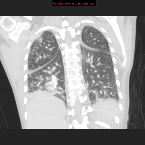 File:Avascular necrosis in sickle cell disease (Radiopaedia 17448-17152 B 95).jpg