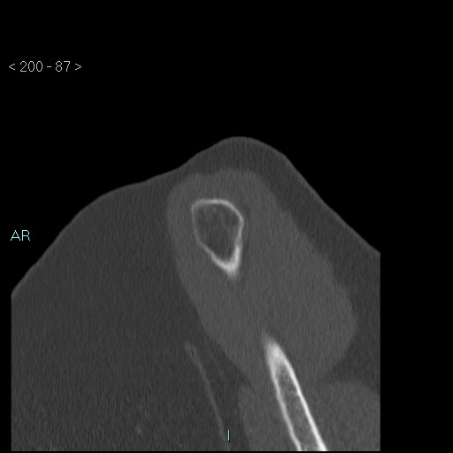 Avascular necrosis of the shoulder - Cruess stage I (Radiopaedia 77674-89887 Sagittal bone window 86).jpg