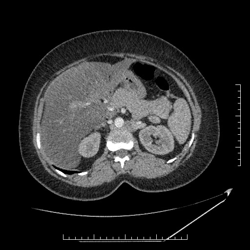 File:Azygos continuation of the IVC (Radiopaedia 40416-42965 A 27).jpg