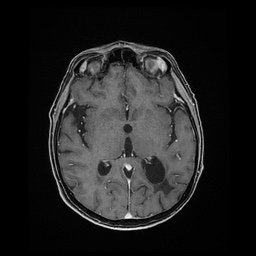 Balo concentric sclerosis (Radiopaedia 53875-59982 Axial LAVA C+ 135).jpg