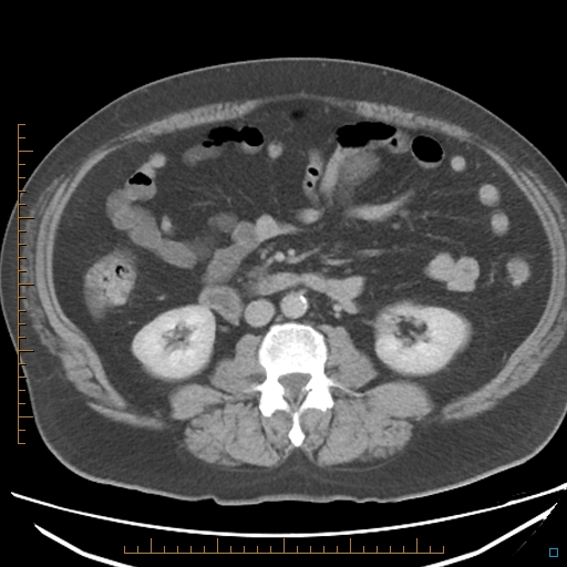 File:Bariatric balloon causing gastric outlet obstruction (Radiopaedia 54449-60672 A 21).jpg
