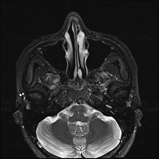 File:Basal cell carcinoma - nasal region (Radiopaedia 70292-80365 Axial STIR 13).jpg