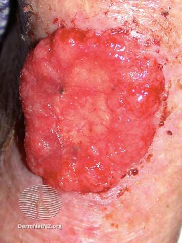 Basal cell carcinoma affecting the face (DermNet NZ lesions-bcc-face-0883).jpg