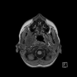 Base of skull rhabdomyosarcoma (Radiopaedia 32196-33142 Axial T1 3).jpg