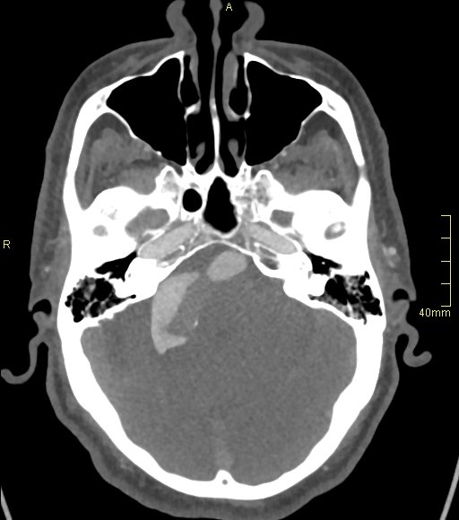 File:Basilar artery aneurysm (Radiopaedia 56261-62932 A 55).jpg