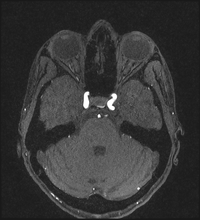 Basilar artery perforator aneurysm (Radiopaedia 82455-97733 Axial MRA 80).jpg