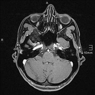 File:Basilar artery perforator aneurysm (Radiopaedia 82455-99523 G 24).jpg