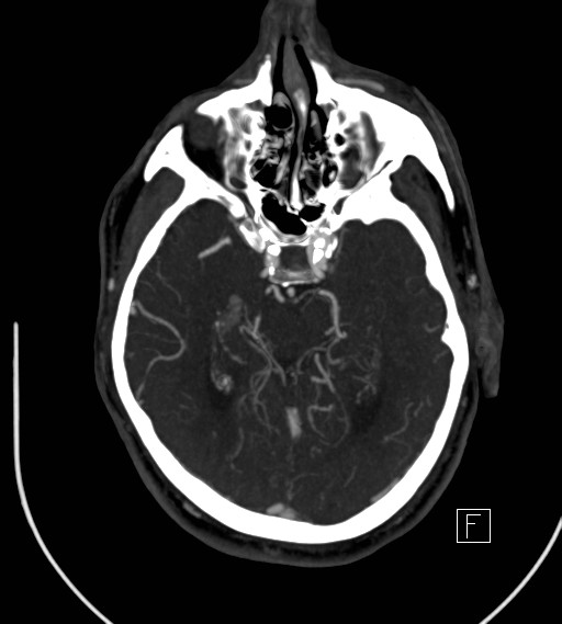 Basilar artery thrombosis (Radiopaedia 26986-27163 A 38).jpg