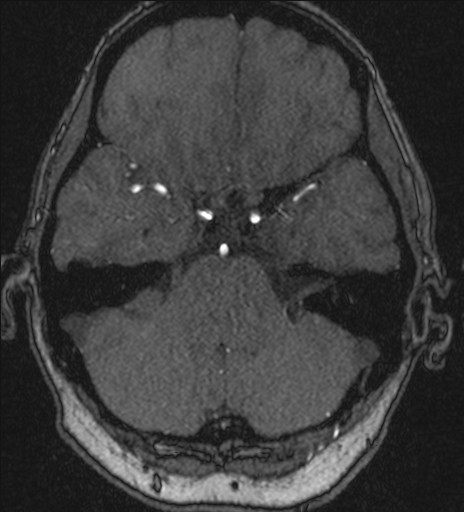 Basilar tip aneurysm (Radiopaedia 26504-26632 MRA 62).jpg