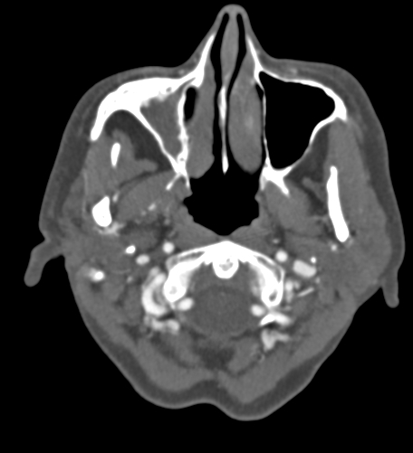 Basilar tip aneurysm with coiling (Radiopaedia 53912-60086 A 11).jpg
