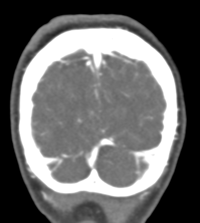 Basilar tip aneurysm with coiling (Radiopaedia 53912-60086 B 144).jpg