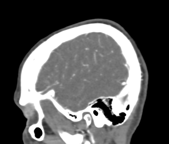 Basilar tip aneurysm with coiling (Radiopaedia 53912-60086 C 17).jpg