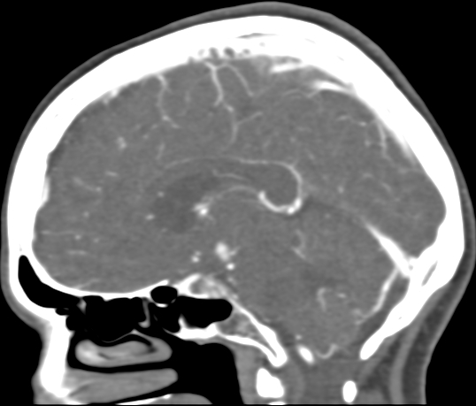 Basilar tip aneurysm with coiling (Radiopaedia 53912-60086 C 71).jpg