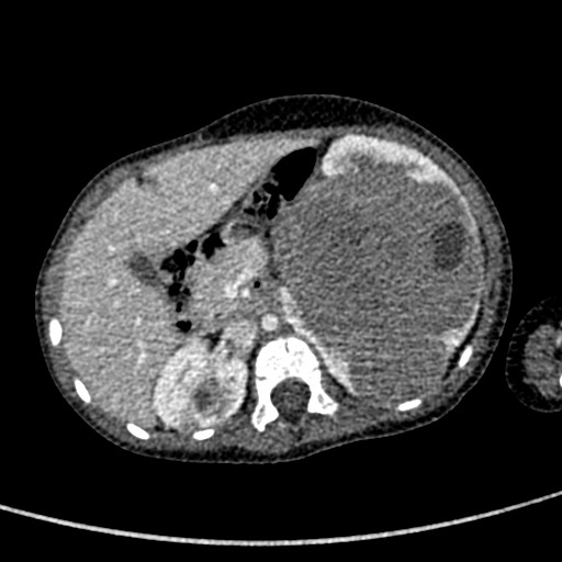 Beckwith-Wiedeman syndrome with bilateral Wilms tumors (Radiopaedia 60850-68629 A 56).jpg