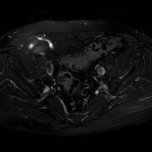 File:Benign prostatic nodular hyperplasia (Radiopaedia 16917-16634 Axial T2 fat sat 1).jpg