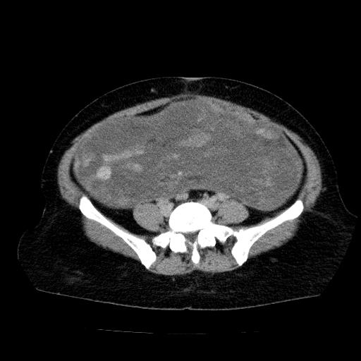 Benign spindle cell tumor - abdominopelvic (Radiopaedia 61300-69212 Axial C+ delayed 43).jpg