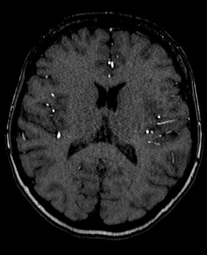 File:Berry aneurysm of the terminal internal carotid artery (Radiopaedia 88286-104918 Axial TOF 139).jpg