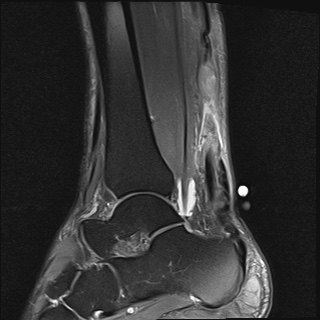 File:Bilateral Achilles tendon complete tear (Radiopaedia 81344-95051 Sagittal T2 fat sat 9).jpg