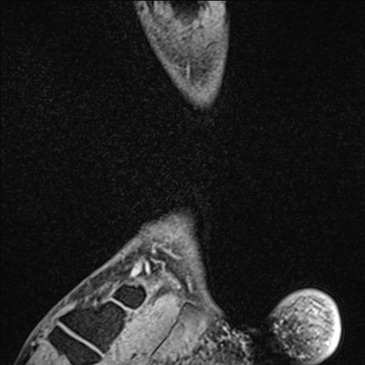 Bilateral Achilles tendon complete tear (Radiopaedia 81344-95051 Sagittal WE - Right 95).jpg
