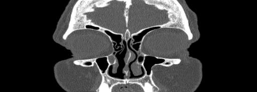 Bilateral Ectopic Infraorbital Nerves (Radiopaedia 49006-54084 Coronal bone window 10).jpg