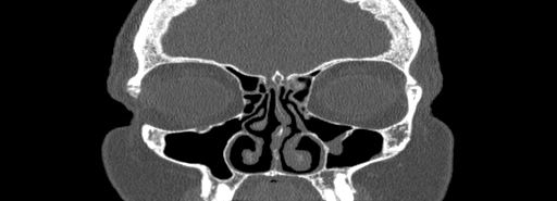 File:Bilateral Ectopic Infraorbital Nerves (Radiopaedia 49006-54084 Coronal bone window 20).jpg